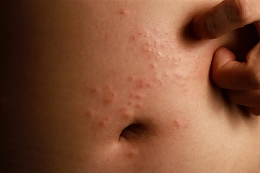 Flåt i haven? 3 tegn på Lyme-borreliose du aldrig må ignorere