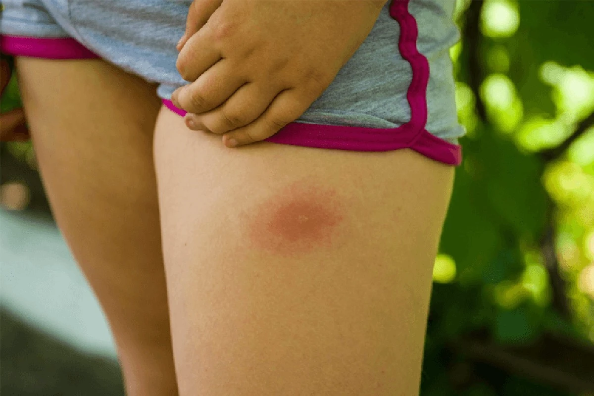 Flåt i haven? 3 tegn på Lyme-borreliose du aldrig må ignorere - image 1